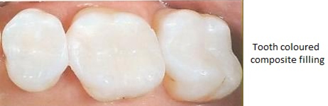 White Composite Fillings