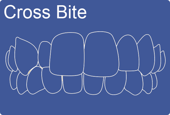 Invisalign can fix crossbite