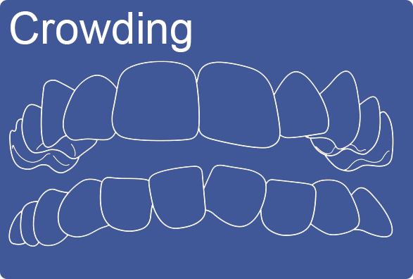 Invisalign can fix crowded teeth