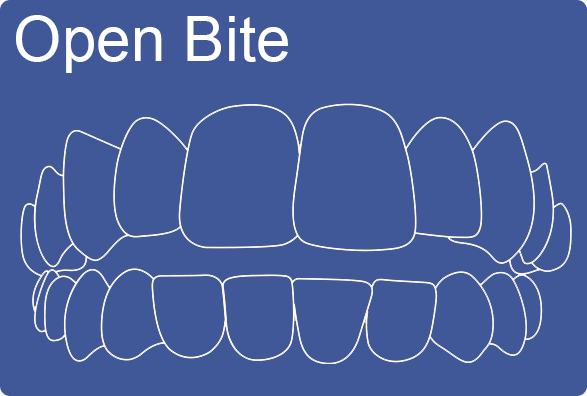 Invisalign can fix Open Bite