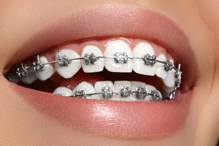 Dental Braces for Adults