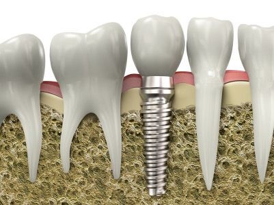 Dental Implants vs. Dentures
