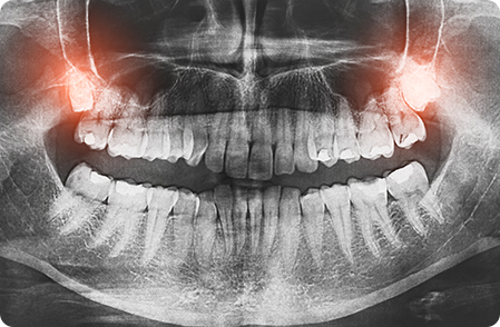 Wisdome Teeth X-Ray - Removal of Wisdome Teeth